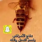لسع بنحل