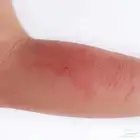 مين موجود  بالسعودية ويعاني من  الاكزيما