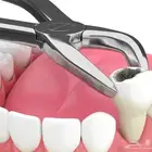خلع اسنان بشكل مجاني لجميع الجنسيات شامل الاشعة والفحص