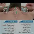 الحجامة النبوية علاج وشفاء وراحة نفسية خبرة لسنوات الحمد لله