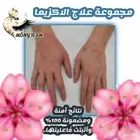 ود ع الحكة والمعاناة مع الأكزيما