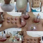 حجامه طبيه على السنه النبويه