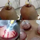 حجامه طبيه على السنه النبويه