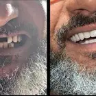 طقم متحرك لتعويض الأسنان المفقوده