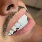 ابتسامه هواليود سمايل