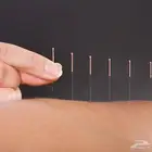 جلسات الإبر صينيه
