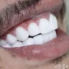 عروض على ابتسامة هوليود المتحركه اقساط