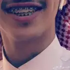 تقويم اسنان زينه 60