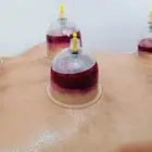 متخصص حجامة