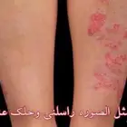 مجموع الاكزيما