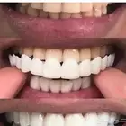 ابتسامة هوليود متحركة