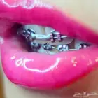 تقويم أسنان زينه