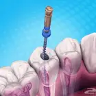علاجات اسنان سحب عصب بشكل مجاني لجميع الجنسيات