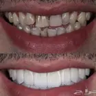 عروض الاسنان