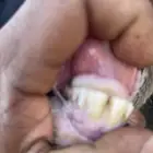ثنيه مشروكه
