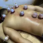 جلسات حجامه ( متنوعه