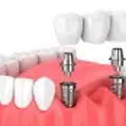 استعد لابتسامتك من جديد
