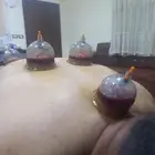 الحجامة النبوية والابر الصينية والتغذيه العلاجيه