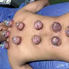 متخصص حجامة منزلية خبرة اكثر من 5 سنوات
