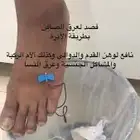 فصد عرق النسا والآم الظهر
