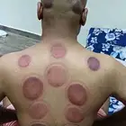 متخصص حجامة منزلية خبرة اكثر من 5 سنوات