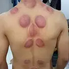 متخصص حجامة منزلية خبرة اكثر من 5 سنوات