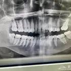 حشوات اسنان مجانا ( الاشعه فقط تدفع من المريض مره وحده )
