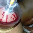 الحجامه النبويه الشريفه   كل انواع الحجامه