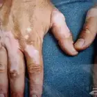 علاج البهاق الطرفي والعام