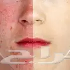 زيراكتان 20 روكتان 20