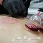 أخصائي حجامة-زيارات منزلية
