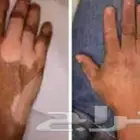 للتخلص من البهاق راسلني خاص