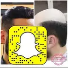 بديل الزراعة تركيب شعر طبيعي بوستيجه
