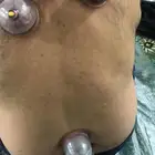 الحجامه علاج لكل داء وسنه نبويه