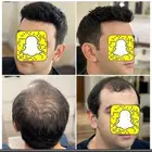 بديل الزراعه لصق شعر طبيعي