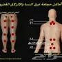 الحجامة الم الراس والكتوف والظهر