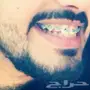 تقويم اسنان زينة 