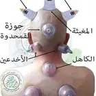 الحجامه شفا وعافيه