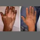 للتخلص من البهاق بأفضل المنتجات الطبيعيه خالي كورتيزون