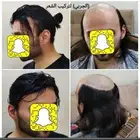 حل الصلع والثعلبه تركيب بديل الزراعة