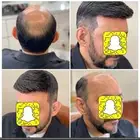 بديل الزراعة حل الصلع الدائم