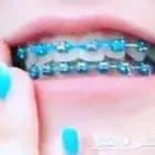 تقويم أسنان زينه