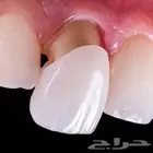 تقديم علاج للاسنان مجانا