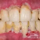 تنظيف جير للحالات الصعبه بشكل مجاني بالكامل