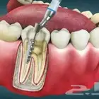 علاج اسنان