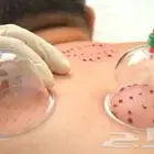 حجامة أخصائي سعودي