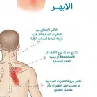 طق ابهر مصع