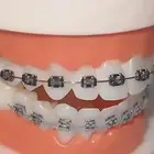 تقويم اسنان