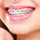 تقويم اسنان جوده 100