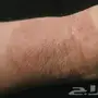أكزيما صدفيه حساسيه